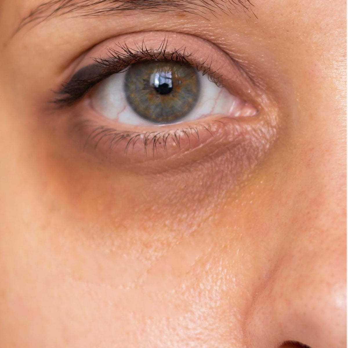 Close-up of an eye before using the EYLUME Calm Heated Eye Mask, showing dryness and mild dark circles